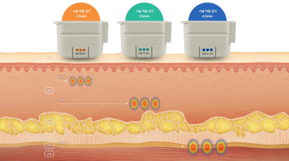 Gangnam Station Ulthera - The Most Reliable Way to Regain a Defined Jawline image 2