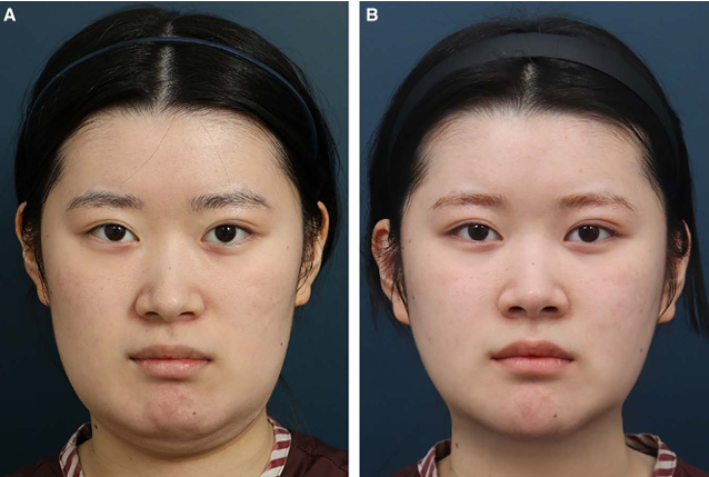 CRMO Patient Underwent Jawline Reduction Surgery — What Were the Results? Real Surgery Process Revealed, Part 2 image 4
