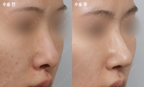 코재수술 늑연골: 자가늑/기증늑(동종늑연골) 어떤 경우에 선택할까 관련 이미지 4