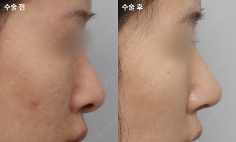 코재수술 늑연골: 자가늑/기증늑(동종늑연골) 어떤 경우에 선택할까 관련 이미지 12