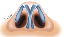 Bulbous Nose Surgery: Is Raising Only the Nose Tip Enough? | Correction Checklist by Cause of Bulbous Nose image 6