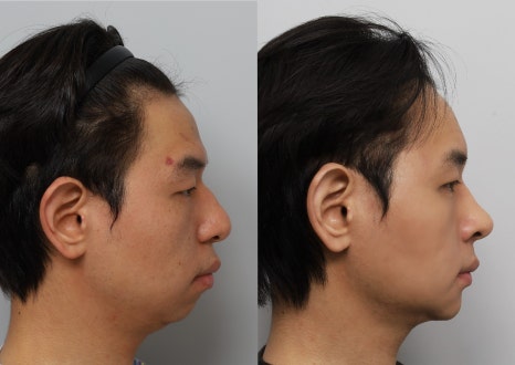 무턱, 턱끝 전진만으로 입체감이 생길까? 턱끝수술 실제 케이스 분석 관련 이미지 5