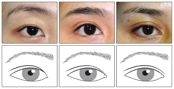 If the inner corner of your eyes feels cramped, consider this instead of Mongolian fold removal image 3