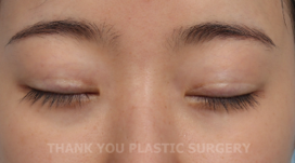 Double Eyelid Revision Surgery Cost: The Real Reason It’s More Expensive Than the First Surgery | What You Must Know Before Eye Revision Surgery image 5