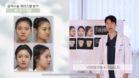 무턱, 이중턱 짧은 턱끝, 턱끝성형으로 V라인 만드는 법 관련 이미지 12