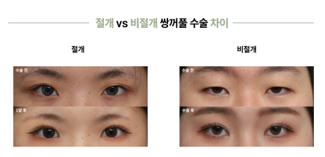 Natural Adhesion vs. Incisional Double Eyelid Surgery: Which One Is Right for Me? | Complete Guide to the Differences Between Non-Incisional Double Eyelid Surgery image 9