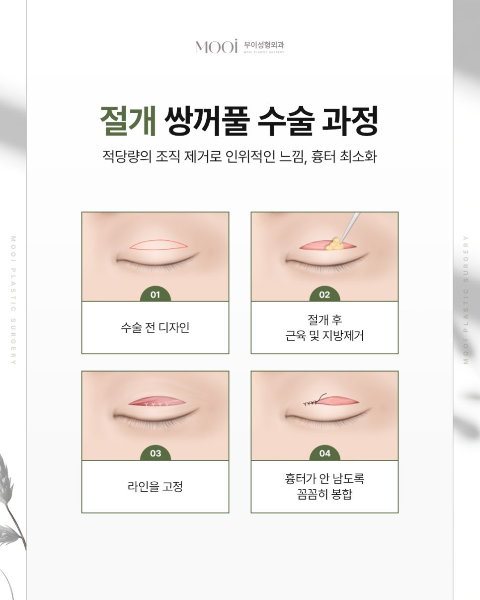Customized Eye Surgery Tips: Incision, Non-Incision, Canthoplasty, and Ptosis Correction Tailored to Your Eyes image 3