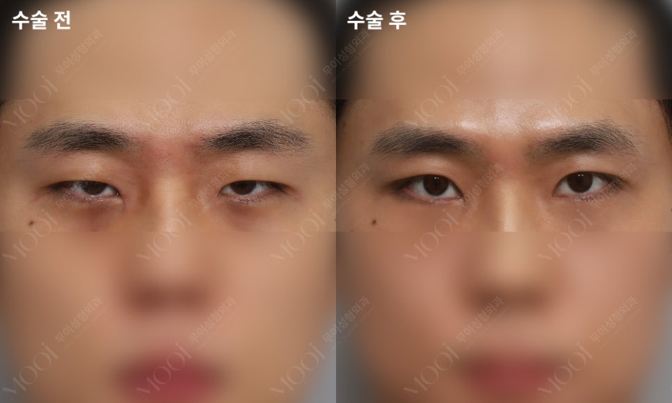 Three Things You Must Know Before Male Epicanthoplasty and Canthoplasty image 3