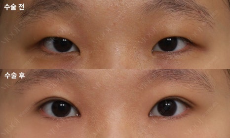 If the inner corner of your eyes feels cramped, consider this instead of Mongolian fold removal image 4