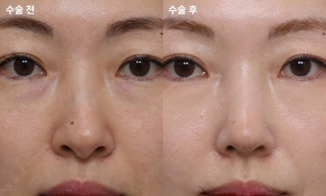 코재수술 늑연골: 자가늑/기증늑(동종늑연골) 어떤 경우에 선택할까 관련 이미지 7