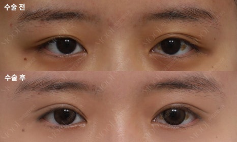 Monolid Epicanthic Fold Incision: Why Repositioning Is Needed Instead of Removal image 6