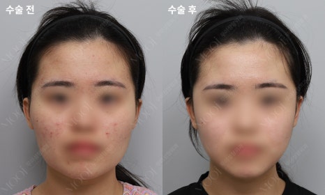 안면윤곽수술 후 회복, 처음 2주가 결과를 만들어요 (뼈수술 관리법 총정리) 관련 이미지 6