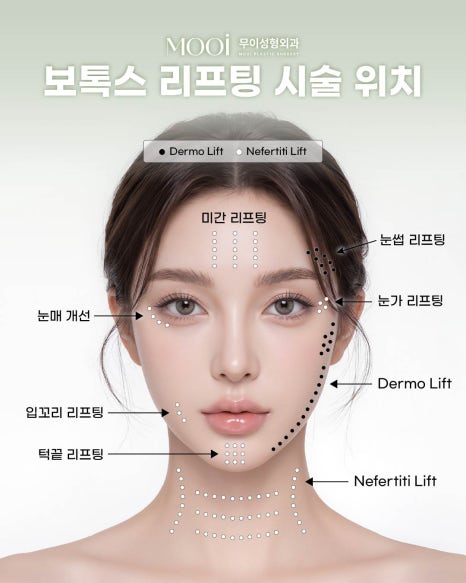 Everything You Need to Know About Botox Lifting: Defining the Jawline and Neckline image 2