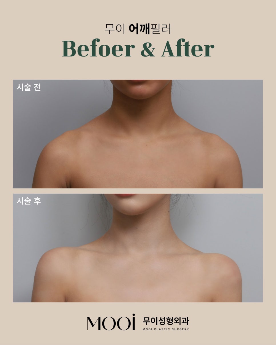 Why Pelvic Fillers and Shoulder Fillers Are About Line Design, Not Just Volume image 2