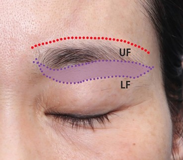 Drooping Eyelid Surgery: A Complete Guide to 3 Methods image 2