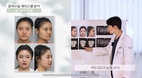 무턱, 이중턱 짧은 턱끝, 턱끝성형으로 V라인 만드는 법 관련 이미지 11