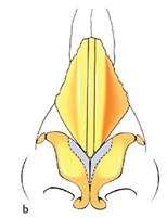 Bulbous Nose Surgery: Is Raising Only the Nose Tip Enough? | Correction Checklist by Cause of Bulbous Nose image 7