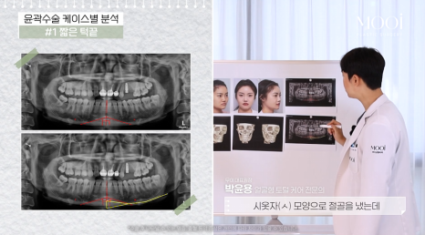 무턱, 이중턱 짧은 턱끝, 턱끝성형으로 V라인 만드는 법 관련 이미지 9