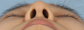 Bulbous Nose Surgery: Is Raising Only the Nose Tip Enough? | Correction Checklist by Cause of Bulbous Nose image 10