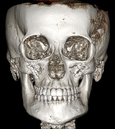 CRMO Patient Underwent Jawline Reduction Surgery — What Were the Results? Real Surgery Process Revealed, Part 2 image 3
