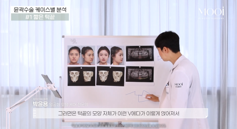 무턱, 이중턱 짧은 턱끝, 턱끝성형으로 V라인 만드는 법 관련 이미지 10