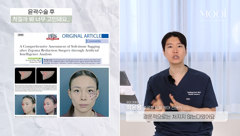 How to Reduce Sagging After Zygoma Reduction or Square Jaw Surgery? (Review of AI Research Findings) image 2