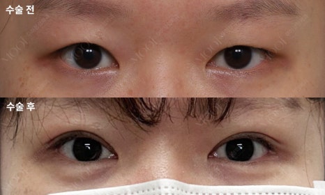 If a Double Eyelid Fold Comes Loose, Do You Need to Repeat Ptosis Correction Too? image 5