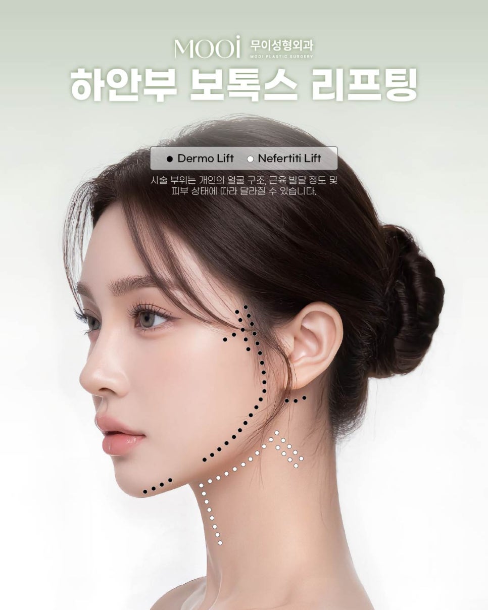 Everything You Need to Know About Botox Lifting: Defining the Jawline and Neckline image 1