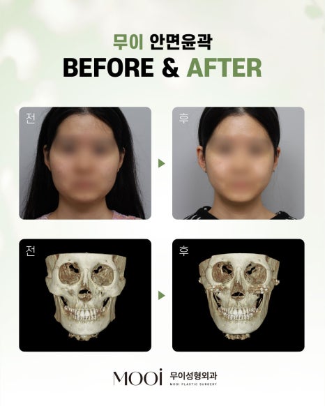 What You Must Check Before Jawline Surgery, and What If Your Jaw Keeps Growing Without a Clear Reason? Part 1 image 4