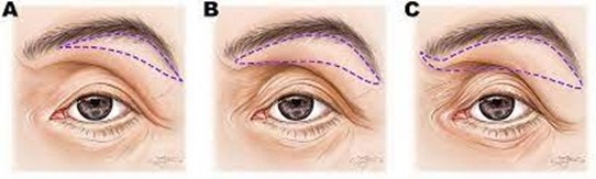 How to Find the Right Surgery for Drooping Eyelids (Upper Blepharoplasty vs Brow Lift Under the Eyebrow vs Endoscopic Forehead Lift) image 4