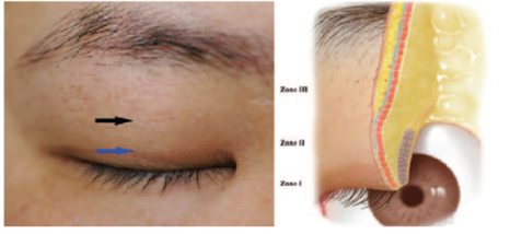 Drooping Eyelid Surgery: A Complete Guide to 3 Methods image 1