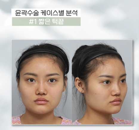 무턱, 이중턱 짧은 턱끝, 턱끝성형으로 V라인 만드는 법 관련 이미지 5
