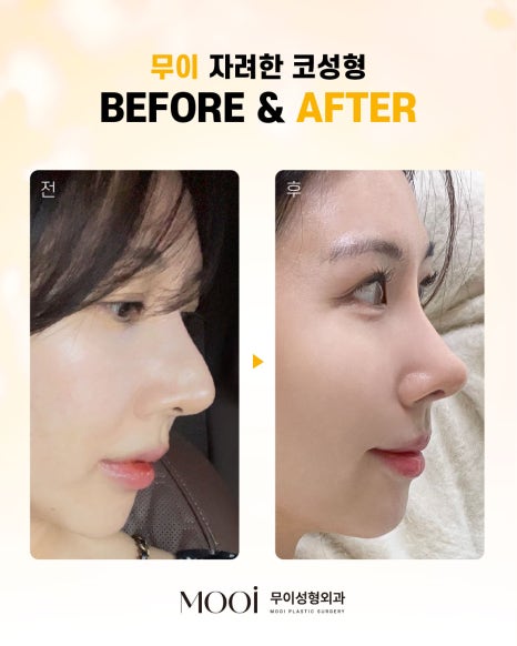 코성형 전후, 무조건 높이는 코보다 관련 이미지 3