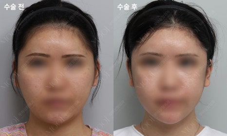 안면윤곽수술 후 회복, 처음 2주가 결과를 만들어요 (뼈수술 관리법 총정리) 관련 이미지 3