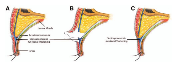 Double Eyelid Revision Surgery Cost: The Real Reason It’s More Expensive Than the First Surgery | What You Must Know Before Eye Revision Surgery image 3