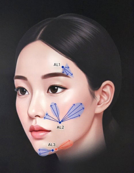 필러로 리프팅이 될까? 레스틸렌 지플랜 필러리프팅 총정리 관련 이미지 7