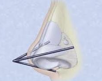 A Complete Summary of the Differences Between Nosing and Nose Filler | Everything About Non-Incisional Rhinoplasty with Lifting Threads image 3