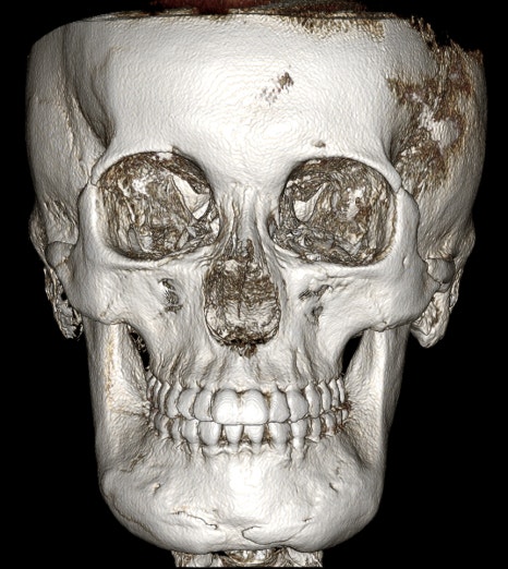CRMO Patient Underwent Jawline Reduction Surgery — What Were the Results? Real Surgery Process Revealed, Part 2 image 2