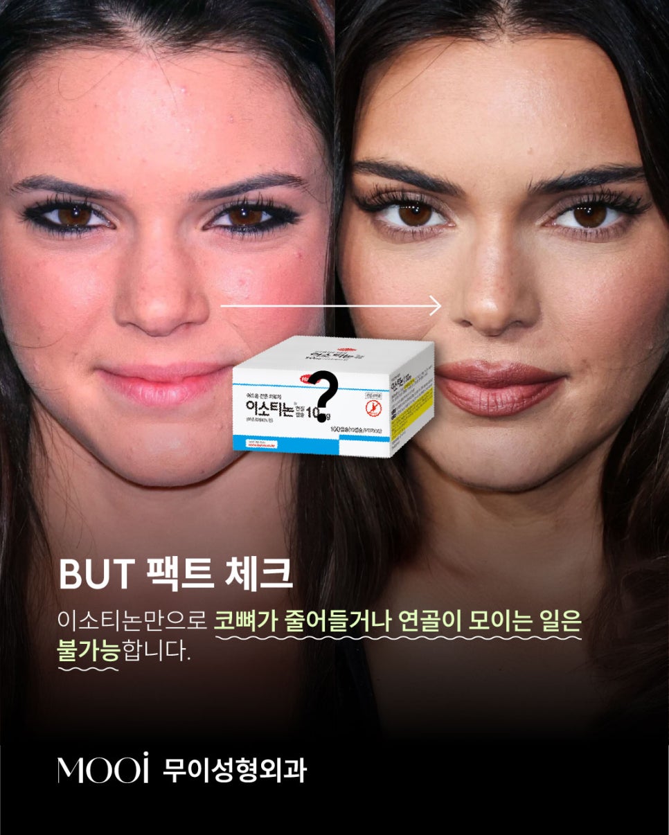 The Truth About Kendall Jenner Videos and the Isotretinoin Nose-Reduction Effect image 3