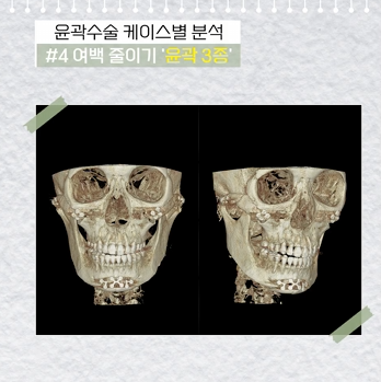 윤곽 2종 3종 차이, 얼굴 여백 줄이기 총정리 관련 이미지 7