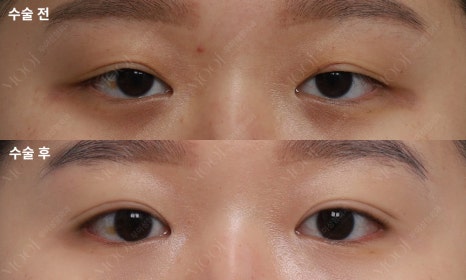 If a Double Eyelid Fold Comes Loose, Do You Need to Repeat Ptosis Correction Too? image 6