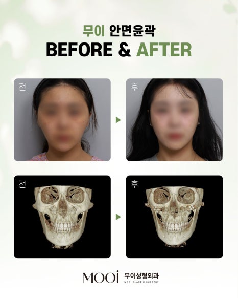 CRMO Patient Underwent Jawline Reduction Surgery — What Were the Results? Real Surgery Process Revealed, Part 2 image 5