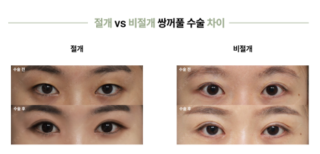 Natural Adhesion vs. Incisional Double Eyelid Surgery: Which One Is Right for Me? | Complete Guide to the Differences Between Non-Incisional Double Eyelid Surgery image 8