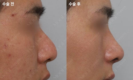 코재수술 늑연골: 자가늑/기증늑(동종늑연골) 어떤 경우에 선택할까 관련 이미지 9