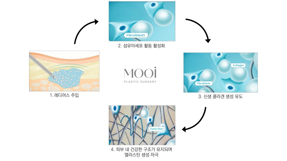 Gangnam Station Radiesse - Filling the Core image 5