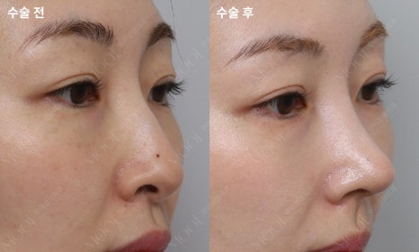 코재수술 늑연골: 자가늑/기증늑(동종늑연골) 어떤 경우에 선택할까 관련 이미지 2