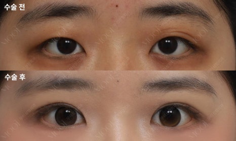 Monolid Epicanthic Fold Incision: Why Repositioning Is Needed Instead of Removal image 5