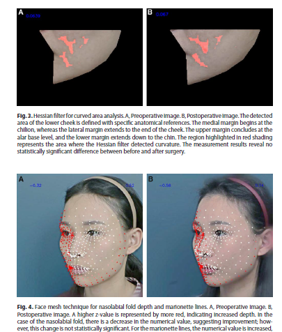 How to Reduce Sagging After Zygoma Reduction or Square Jaw Surgery? (Review of AI Research Findings) image 4