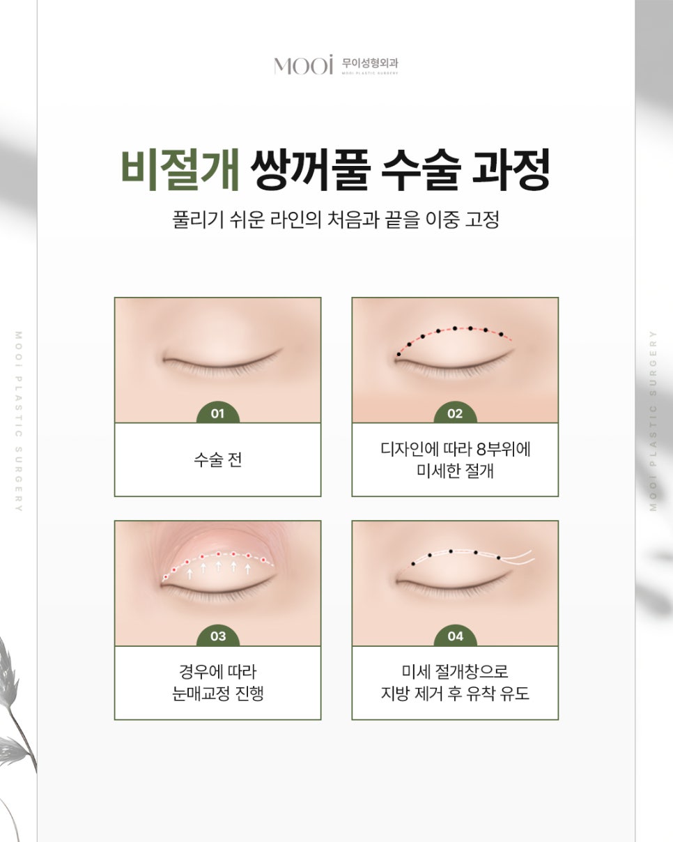 Customized Eye Surgery Tips: Incision, Non-Incision, Canthoplasty, and Ptosis Correction Tailored to Your Eyes image 4