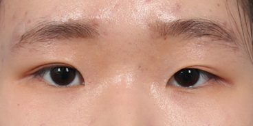 Do You Really Need Epicanthoplasty? Essential Checklist Before Your First Eye Surgery | Epicanthoplasty Side Effects·Cost image 3
